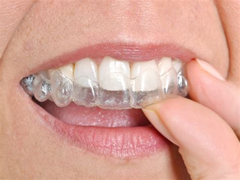 invisalign metal brackets|why does invisalign have bumps.